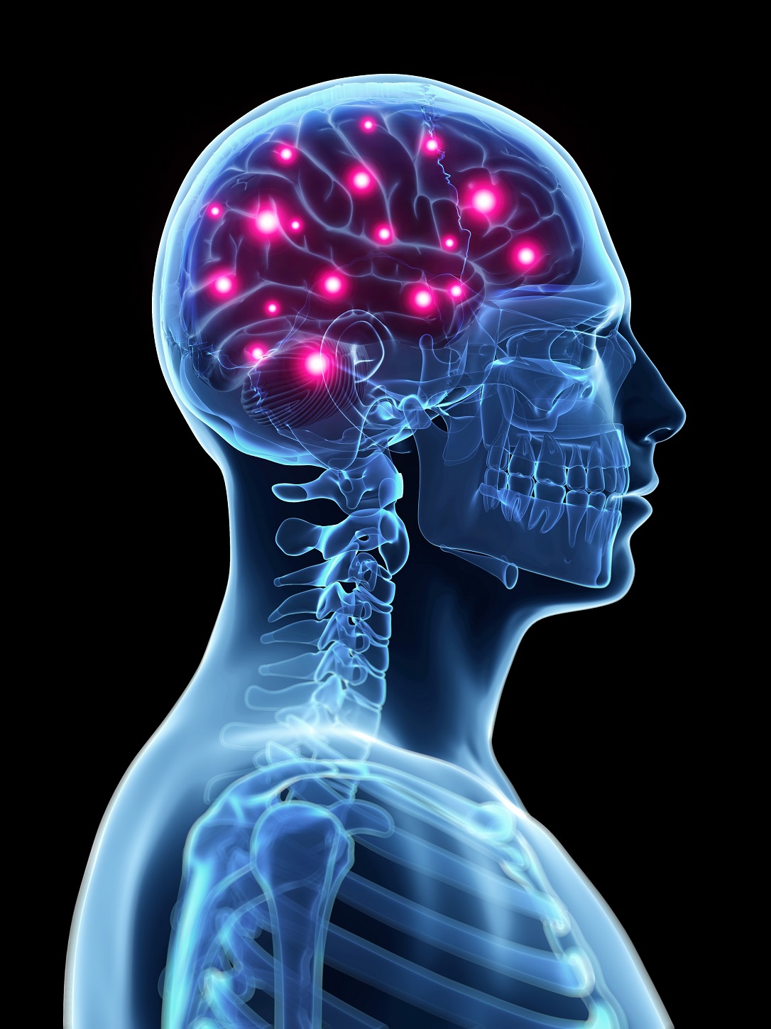 La Stimolazione Cerebrale Profonda Pu Ripristinare Alcune Funzioni Cognitive Cronache Di Scienza